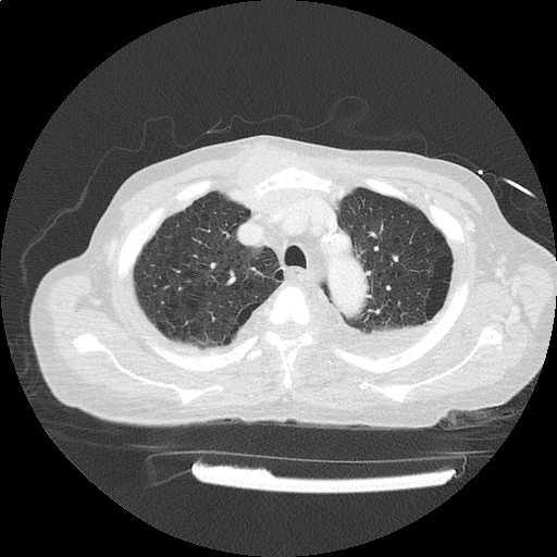 ct_chest_anemia_03